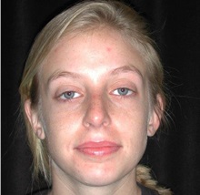 Rhinoplasty After Photo by Frederick Lukash, MD, FACS, FAAP; East Hills, NY - Case 35138