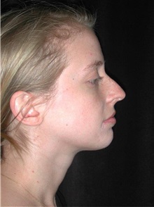 Rhinoplasty Before Photo by Frederick Lukash, MD, FACS, FAAP; East Hills, NY - Case 35138