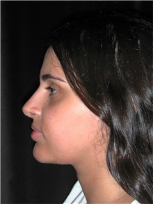 Rhinoplasty After Photo by Frederick Lukash, MD, FACS, FAAP; East Hills, NY - Case 35139