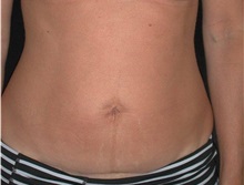 Tummy Tuck After Photo by Frederick Lukash, MD, FACS, FAAP; East Hills, NY - Case 35140