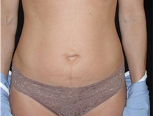 Tummy Tuck Before Photo by Frederick Lukash, MD, FACS, FAAP; East Hills, NY - Case 35140