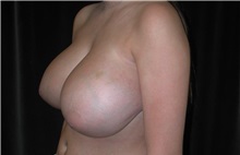 Breast Reduction Before Photo by Frederick Lukash, MD, FACS, FAAP; East Hills, NY - Case 35143