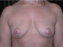 Breast Lift After Photo by Frederick Lukash, MD, FACS, FAAP; East Hills, NY - Case 35144