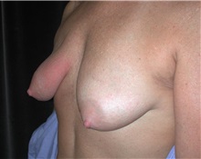 Breast Lift Before Photo by Frederick Lukash, MD, FACS, FAAP; East Hills, NY - Case 35144