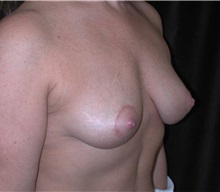 Breast Lift After Photo by Frederick Lukash, MD, FACS, FAAP; East Hills, NY - Case 35144