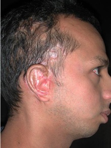 Ear Reconstruction Surgery After Photo by Frederick Lukash, MD, FACS, FAAP; East Hills, NY - Case 35145
