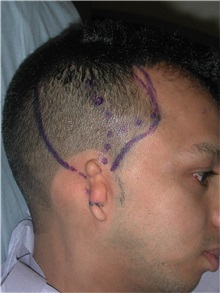 Ear Reconstruction Surgery Before Photo by Frederick Lukash, MD, FACS, FAAP; East Hills, NY - Case 35145