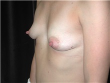 Breast Augmentation Before Photo by Frederick Lukash, MD, FACS, FAAP; East Hills, NY - Case 35146