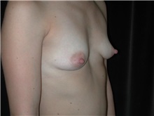 Breast Augmentation Before Photo by Frederick Lukash, MD, FACS, FAAP; East Hills, NY - Case 35146