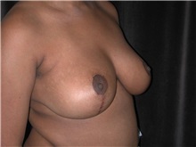 Breast Reduction After Photo by Frederick Lukash, MD, FACS, FAAP; East Hills, NY - Case 35147