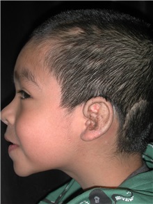 Ear Reconstruction Surgery After Photo by Frederick Lukash, MD, FACS, FAAP; East Hills, NY - Case 35149