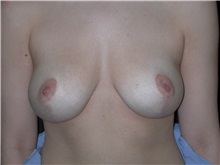 Breast Reduction After Photo by Frederick Lukash, MD, FACS, FAAP; East Hills, NY - Case 35150