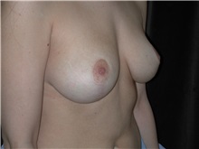 Breast Reduction After Photo by Frederick Lukash, MD, FACS, FAAP; East Hills, NY - Case 35150