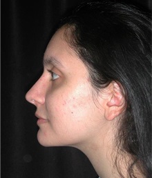 Rhinoplasty After Photo by Frederick Lukash, MD, FACS, FAAP; East Hills, NY - Case 35151