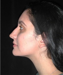 Rhinoplasty Before Photo by Frederick Lukash, MD, FACS, FAAP; East Hills, NY - Case 35151