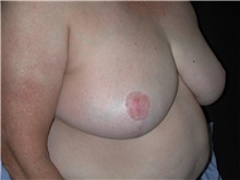 Breast Reduction After Photo by Frederick Lukash, MD, FACS, FAAP; East Hills, NY - Case 35153