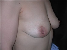 Breast Lift Before Photo by Frederick Lukash, MD, FACS, FAAP; East Hills, NY - Case 35257