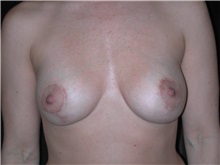 Breast Lift After Photo by Frederick Lukash, MD, FACS, FAAP; East Hills, NY - Case 35258