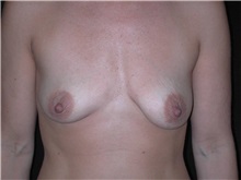 Breast Lift Before Photo by Frederick Lukash, MD, FACS, FAAP; East Hills, NY - Case 35258