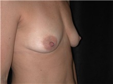 Breast Lift Before Photo by Frederick Lukash, MD, FACS, FAAP; East Hills, NY - Case 35258