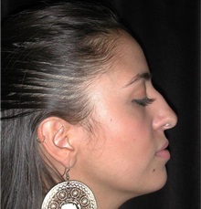 Rhinoplasty Before Photo by Frederick Lukash, MD, FACS, FAAP; East Hills, NY - Case 35421