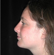 Rhinoplasty After Photo by Frederick Lukash, MD, FACS, FAAP; East Hills, NY - Case 37615