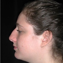 Rhinoplasty Before Photo by Frederick Lukash, MD, FACS, FAAP; East Hills, NY - Case 37615