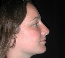 Rhinoplasty After Photo by Frederick Lukash, MD, FACS, FAAP; East Hills, NY - Case 37615