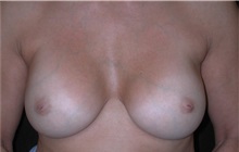Breast Augmentation After Photo by Frederick Lukash, MD, FACS, FAAP; East Hills, NY - Case 38379