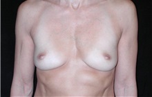 Breast Augmentation Before Photo by Frederick Lukash, MD, FACS, FAAP; East Hills, NY - Case 38379