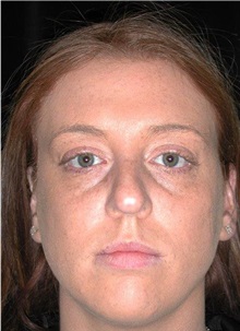 Rhinoplasty Before Photo by Frederick Lukash, MD, FACS, FAAP; East Hills, NY - Case 38380