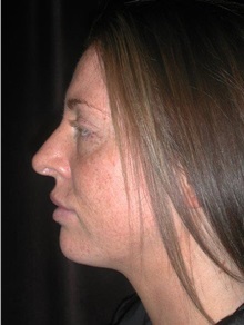 Rhinoplasty After Photo by Frederick Lukash, MD, FACS, FAAP; East Hills, NY - Case 38380