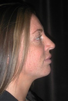 Rhinoplasty After Photo by Frederick Lukash, MD, FACS, FAAP; East Hills, NY - Case 38380