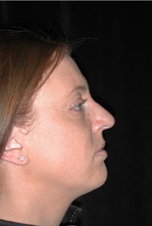 Rhinoplasty Before Photo by Frederick Lukash, MD, FACS, FAAP; East Hills, NY - Case 38380