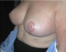 Breast Reduction After Photo by Frederick Lukash, MD, FACS, FAAP; East Hills, NY - Case 38381