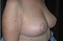 Breast Reduction After Photo by Frederick Lukash, MD, FACS, FAAP; East Hills, NY - Case 38381