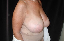 Breast Reduction Before Photo by Frederick Lukash, MD, FACS, FAAP; East Hills, NY - Case 38381