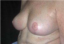 Breast Reduction After Photo by Frederick Lukash, MD, FACS, FAAP; East Hills, NY - Case 38382