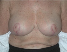 Breast Reduction After Photo by Frederick Lukash, MD, FACS, FAAP; East Hills, NY - Case 41049
