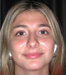 Rhinoplasty After Photo by Frederick Lukash, MD, FACS, FAAP; East Hills, NY - Case 41723