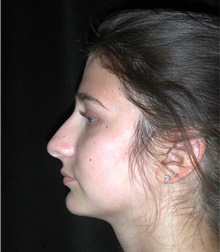 Rhinoplasty Before Photo by Frederick Lukash, MD, FACS, FAAP; East Hills, NY - Case 41723