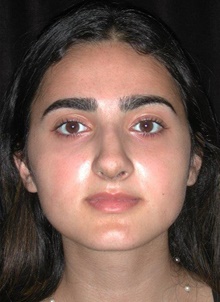 Rhinoplasty After Photo by Frederick Lukash, MD, FACS, FAAP; East Hills, NY - Case 41725