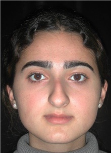 Rhinoplasty Before Photo by Frederick Lukash, MD, FACS, FAAP; East Hills, NY - Case 41725