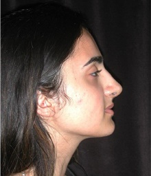 Rhinoplasty After Photo by Frederick Lukash, MD, FACS, FAAP; East Hills, NY - Case 41725