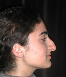 Rhinoplasty Before Photo by Frederick Lukash, MD, FACS, FAAP; East Hills, NY - Case 41725