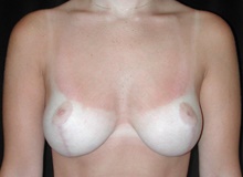 Breast Reduction After Photo by Frederick Lukash, MD, FACS, FAAP; East Hills, NY - Case 44866