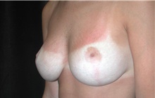 Breast Reduction After Photo by Frederick Lukash, MD, FACS, FAAP; East Hills, NY - Case 44866