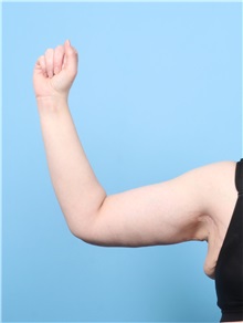 Arm Lift After Photo by Lauren Daly, MD; ,  - Case 50285