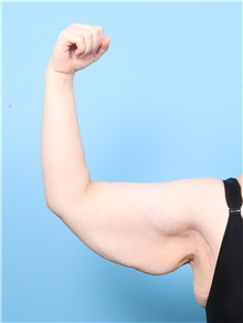 Arm Lift Before Photo by Lauren Daly, MD; ,  - Case 50285