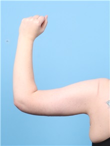 Arm Lift After Photo by Lauren Daly, MD; ,  - Case 50285